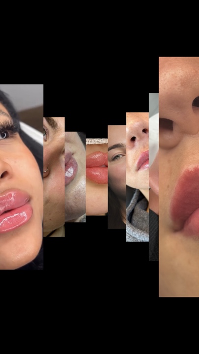 Lip filler