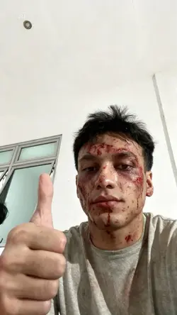 prank injury