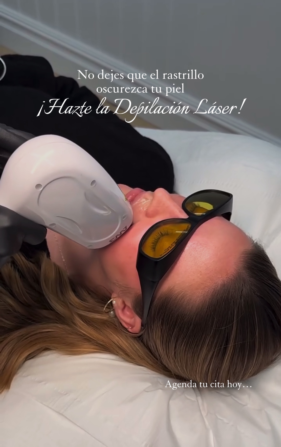 Depilación láser 