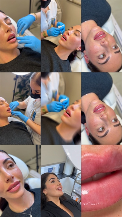 Lip filler