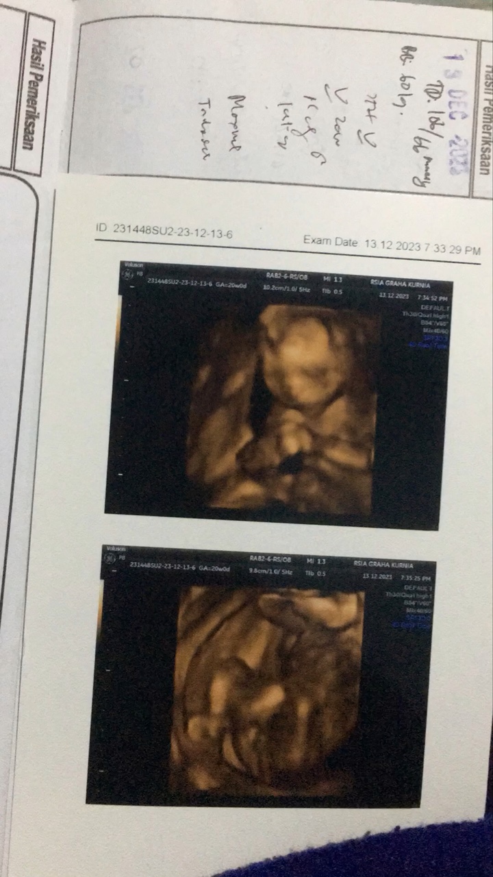 USG Baby boy