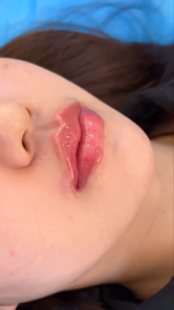 Lip filler