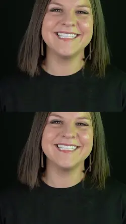 Before after facets