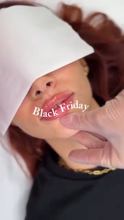 Lip filler