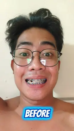 BRACES JOURNEY