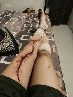 ai injury