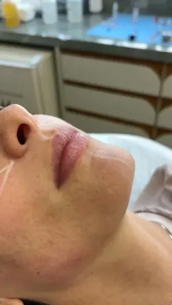 Preenchimento Labial