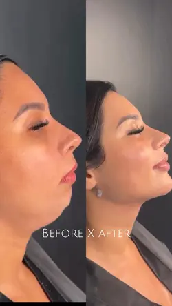 chin LIPO  aesthetic
