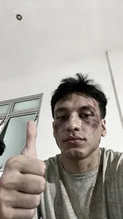 ai luka wajah 