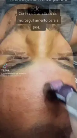 microagulhamento 