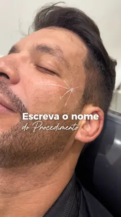 harmonização facial